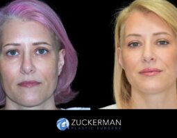 Zuckerman Plastic Surgery