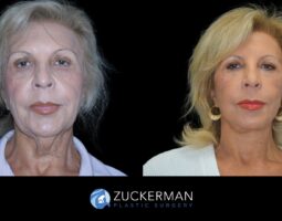 Zuckerman Plastic Surgery