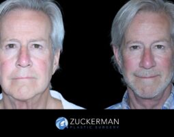 Zuckerman Plastic Surgery
