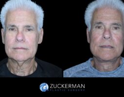 Zuckerman Plastic Surgery