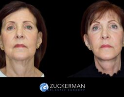Zuckerman Plastic Surgery