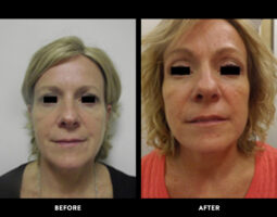 Rowe Plastic Surgery
