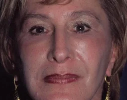 Leonard Grossman MD Plastic Surgeon