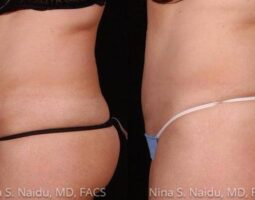 Nina S. Naidu, MD FACS