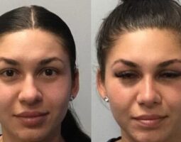 Affordable Plastic Surgery