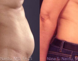 Nina S. Naidu, MD FACS